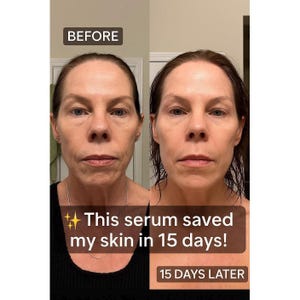May include: A split image showing a woman's face before and after using a serum. The left side is labelled "BEFORE", the right side "15 DAYS LATER". Text on the image reads: "This serum saved my skin in 15 days!"