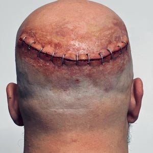 May include: A close-up of the back of a shaved head with a long, stitched wound across the top. The wound is held together with metal staples. The skin around the wound is red and irritated.