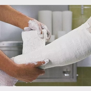 May include: A medical professional applying a white cast to a patient's arm. The arm is wrapped in a white bandage, and the hands are covered in a white substance. The background includes white cylindrical objects and a metal cabinet.