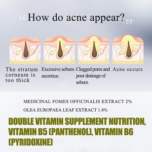 May include: An educational diagram showing the stages of acne formation, with text explaining the process. The image also lists ingredients: Medicinal Fomes Officinalis Extract 2%, Olea Europaea Leaf Extract 1.4%, and Double Vitamin Supplement Nutrition.