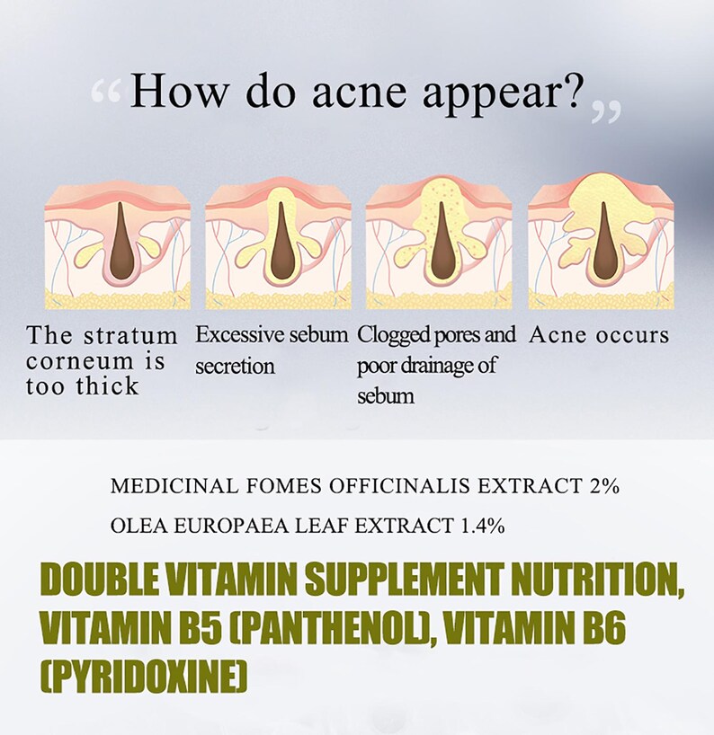 May include: An educational diagram showing the stages of acne formation, with text explaining the process. The image also lists ingredients: Medicinal Fomes Officinalis Extract 2%, Olea Europaea Leaf Extract 1.4%, and Double Vitamin Supplement Nutrition.