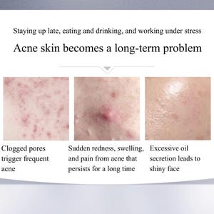 May include: An informational graphic with text about acne. The text reads: "Staying up late, eating and drinking, and working under stress. Acne skin becomes a long-term problem." The image shows examples of acne.