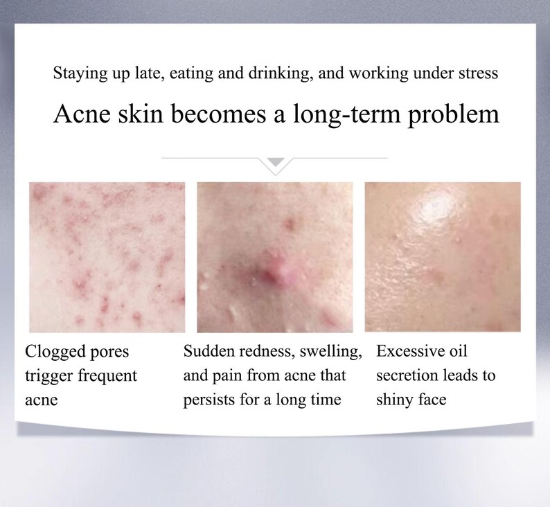 May include: An informational graphic with text about acne. The text reads: "Staying up late, eating and drinking, and working under stress. Acne skin becomes a long-term problem." The image shows examples of acne.