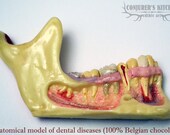 Chocolate Dental Disease