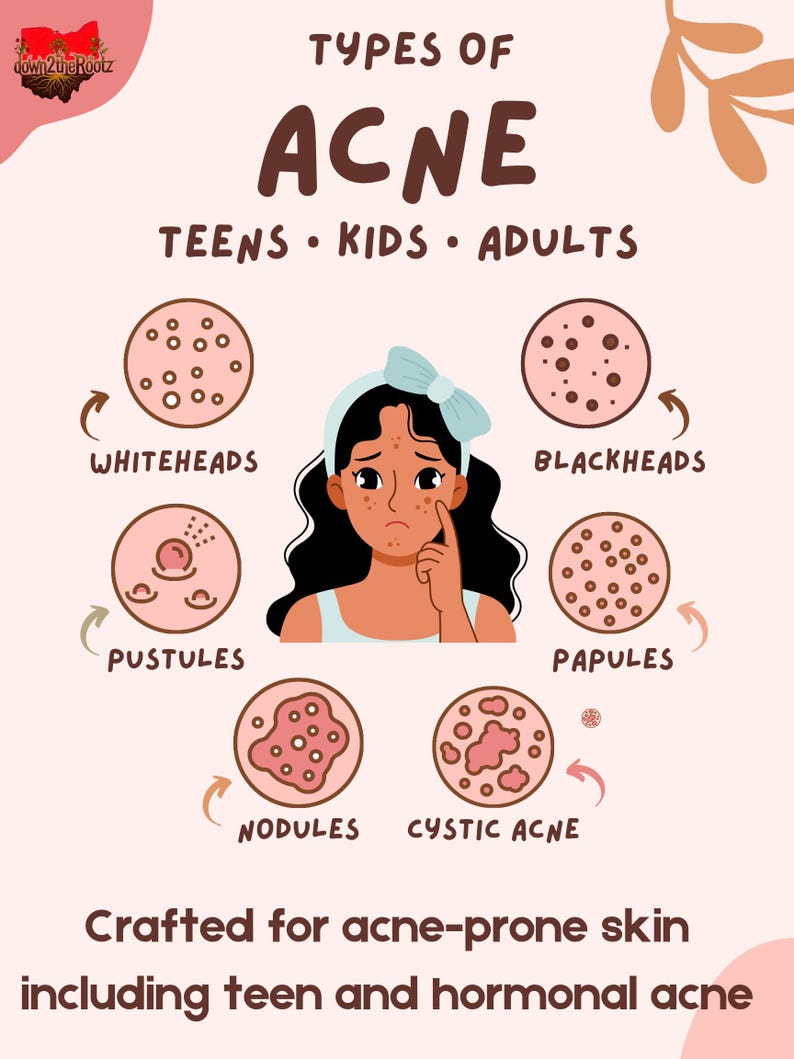 Acne Balm For Pimples • Teen & Adult Post Acne Care • Sensitive Skin • Herbal Salve • Pimple Popper Bild 3