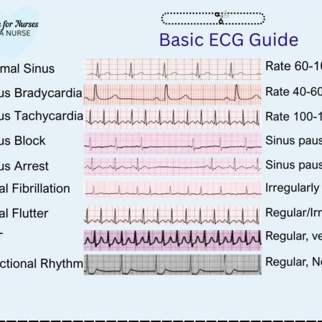 Easy Ecg Rythm Guide ECG Rhythm Guide for Nurses: EKG Cheat Sheet (digital Download) - Etsy