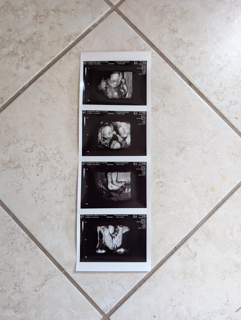 May include: A strip of four black and white ultrasound images, showing developing fetus. The images are rectangular and arranged vertically on a white background. The images are on a tiled floor.