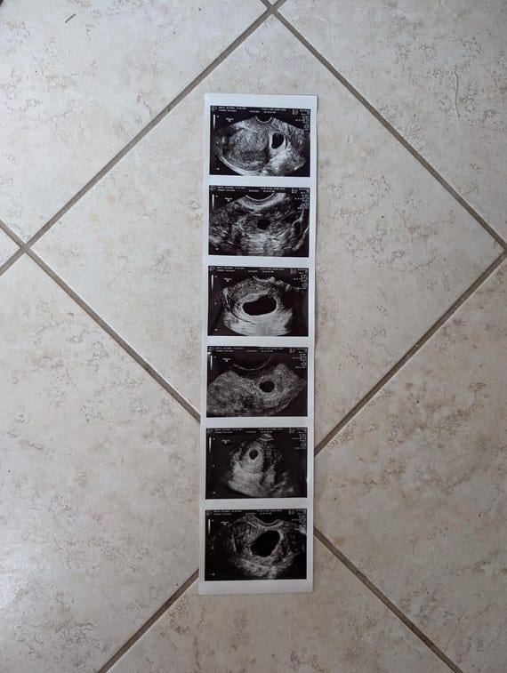 Pregnancy Keepsake - Your Ultrasound Image Print Outs on REAL MEDICAL GRADE Ultrasound Paper