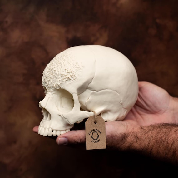 Life Size Human Skull With Bone Cancer Realistic Replica Rare