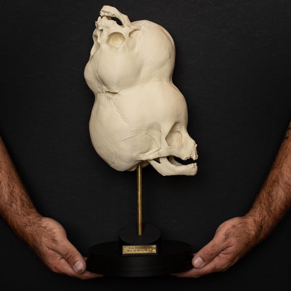 Two-headed Boy of Bengal Skull Replica: Gothic Medical Oddity