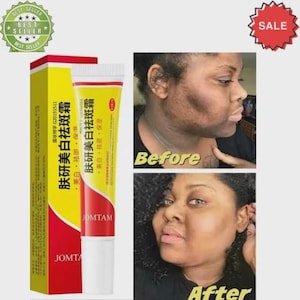 Skin Renewal Face Cream, Melasma Cream, Pigmentation Removal Cream, Dark Spot