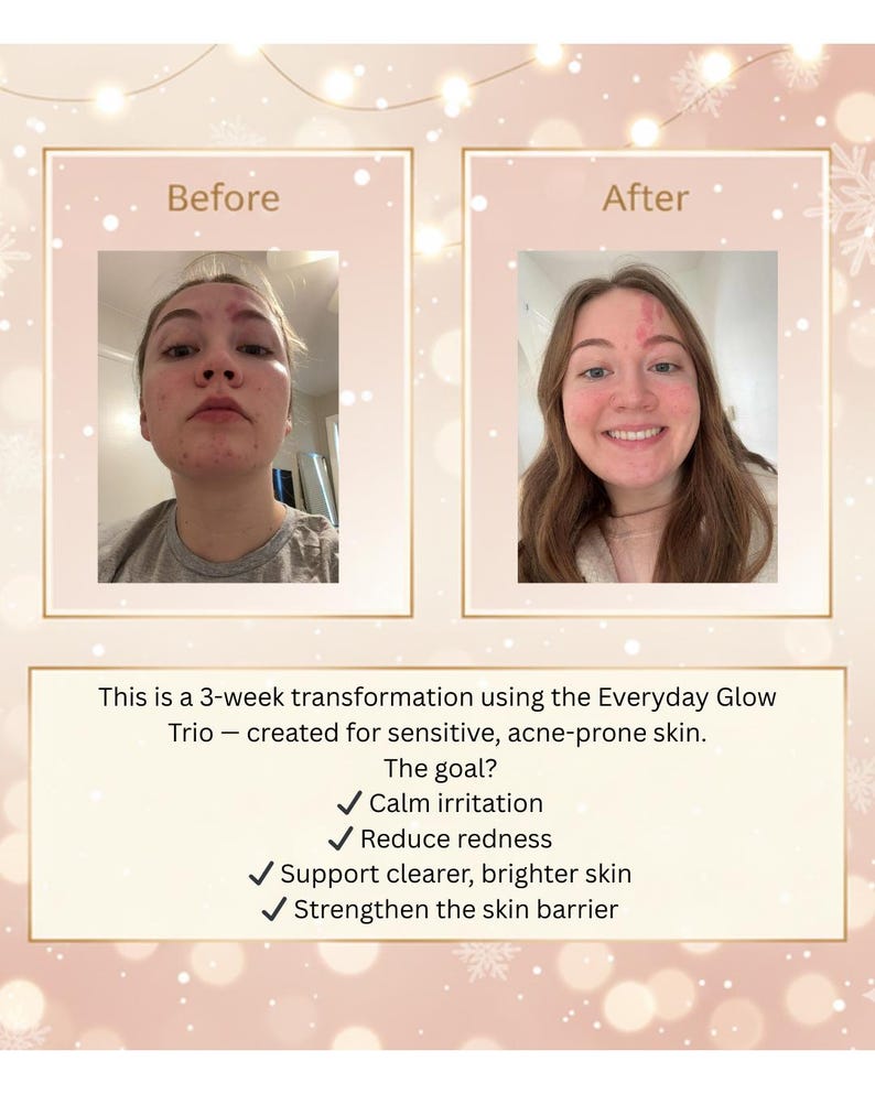 Side-by-side acne and redness before-and-after photos of a young woman showing visible improvement after three weeks using the Kiwi + Coral Everyday Glow Trio. The ‘before’ image shows redness and breakouts on the forehead, cheeks, and chin. The ‘after’ image shows smoother skin with reduced redness and fewer blemishes. Background includes a soft pastel holiday design with warm glowing lights and sparkles.