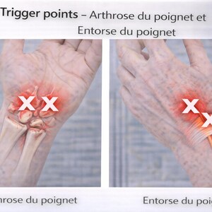 May include: Anatomy diagram showing trigger points on the wrist. The image displays two hands, one with bone structure and the other with tendons. White "X" marks indicate trigger points, with text in French: "Arthrose du poignet" and "Entorse du poignet".