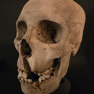 Menschenschädel Lebensgroße Replik auf Ständer- Breitschwertwunde - Momento Mori