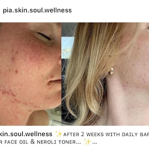 Puede incluir: Imagen dividida que muestra un perfil facial antes y despu&eacute;s de un tratamiento para el cuidado de la piel. El lado izquierdo muestra enrojecimiento e imperfecciones, mientras que el lado derecho muestra una piel mejorada. El texto incluye "pia.skin.soul.wellness" y "DESPU&Eacute;S DE 2 SEMANAS CON DAILY BARRIER REPAIR FACE OIL & NEROLI TONER..."