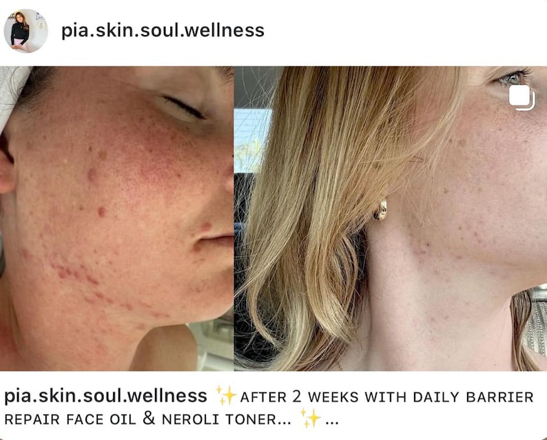 Puede incluir: Imagen dividida que muestra un perfil facial antes y despu&eacute;s de un tratamiento para el cuidado de la piel. El lado izquierdo muestra enrojecimiento e imperfecciones, mientras que el lado derecho muestra una piel mejorada. El texto incluye "pia.skin.soul.wellness" y "DESPU&Eacute;S DE 2 SEMANAS CON DAILY BARRIER REPAIR FACE OIL & NEROLI TONER..."