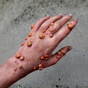 Może przedstawiać: Dłoń z licznymi, uniesionymi, żółto-brązowymi, okrągłymi naroślami. Skóra jest blada z widocznymi czerwonymi żyłami. Narośla różnią się wielkością i są skupione w niektórych obszarach. Tło to gładka, szara powierzchnia.