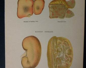 original page - 1916 color MEDICAL CHART from antique medical book - liver, kidney