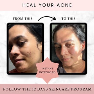 May include: Image showing a before-and-after comparison of a person's face, highlighting acne treatment results. The text "HEAL YOUR ACNE" and "FOLLOW THE 12 DAYS SKINCARE PROGRAM" are displayed. An "INSTANT DOWNLOAD" graphic is also present.