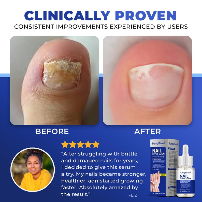 May include: Image showing a before-and-after comparison of a toenail, with text indicating the product is clinically proven. The "before" image shows a damaged nail, while the "after" image shows a healthier nail. A bottle of nail serum is also shown.