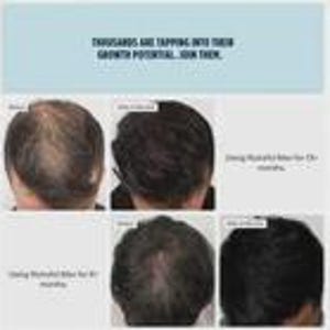 May include: A before-and-after comparison of hair growth, showcasing the results of a product over time. The image includes text at the top that reads, "THOUSANDS ARE TAPPING INTO THEIR GROWTH POTENTIAL... JOIN THEM."
