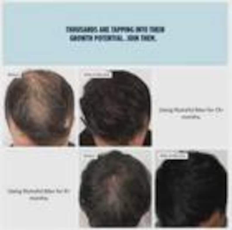 May include: A before-and-after comparison of hair growth, showcasing the results of a product over time. The image includes text at the top that reads, "THOUSANDS ARE TAPPING INTO THEIR GROWTH POTENTIAL... JOIN THEM."