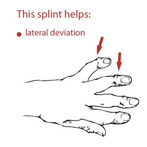 May include: A black and white illustration of a hand with the text "This splint helps: lateral deviation." Red arrows indicate the index and middle fingers. The image is a line drawing.