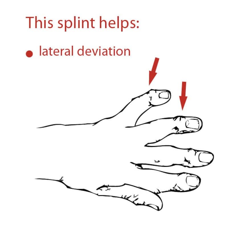May include: A black and white illustration of a hand with the text "This splint helps: lateral deviation." Red arrows indicate the index and middle fingers. The image is a line drawing.