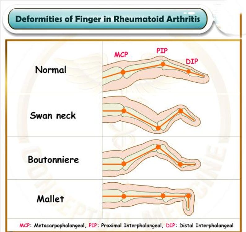 Deformity Example Sterling Swan Finger Splint Ring, Adjustable Joint Support ...