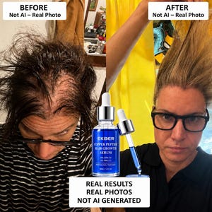 ahk cu results AHK-Cu : r/HairlossResearch CU de 4800 mg favorece el crecimiento capilar Another hair on the pillow.