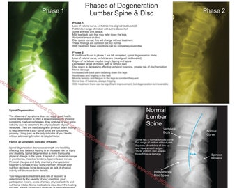 Affiche chiropratique de dégénérescence discale des vertèbres lombaires - 18" X 24" Papier graphique mural de la colonne vertébrale ou laminé