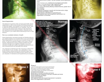 Cervical Vertebral Spinal Disc Degeneration Poster 18" X 24" Chiropractic Wall Chart Laminated or Paper