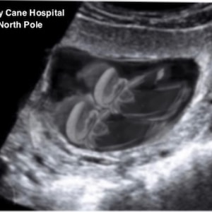 May include: A grayscale ultrasound scan of a foetus. The image includes the text "Candy Cane Hospital North Pole". The foetus is visible within the womb, with its developing features apparent.