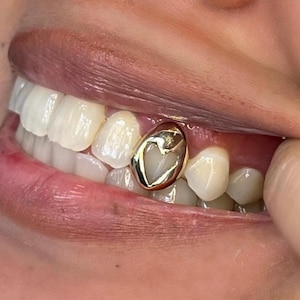 Pode incluir: Close-up de uma boca com uma tampa de dente de ouro. A tampa do dente tem um design em forma de coração. Os lábios da pessoa são de cor rosa claro e os dentes são brancos.