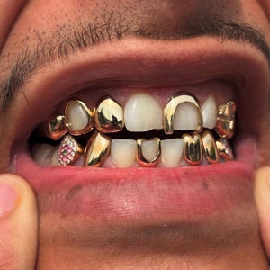 May include: Close-up of a mouth with gold teeth and a pink and white jeweled tooth. The gold teeth are in various shapes, including caps and a U-shape. The person's lips are visible, and the skin around the mouth is tan.