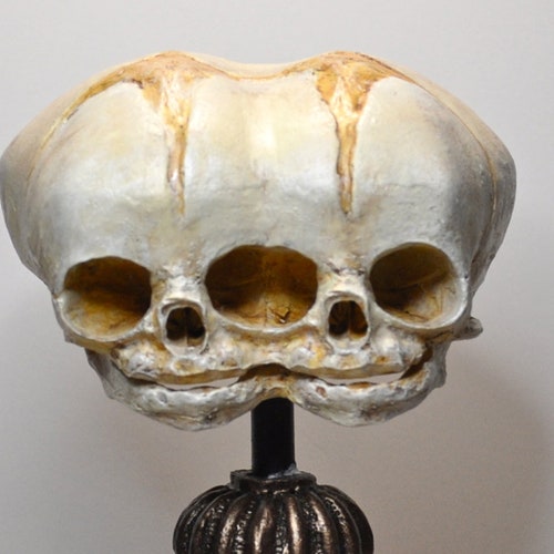 Conjoined Twins Fetal Skull Display
