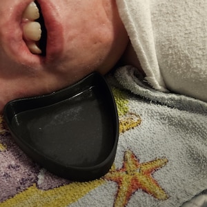May include: A black dental tray is positioned near a person's open mouth. The person is lying on a towel with a starfish design. A white towel is also visible.