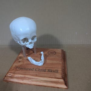 Fractured Child Skull 3D Print | Resin Anatomical Model