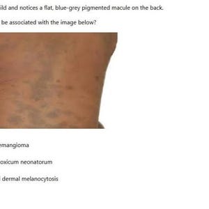 May include: Image shows a close-up of a child's back with flat, blue-grey pigmented macules. The text asks which condition is associated with the image, with options including infantile hemangioma and congenital dermal melanocytosis.