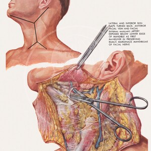 Plate 1: Radical Neck Dissection - 10x14 Giclée Canvas Print of Vintage Surgical Illustration