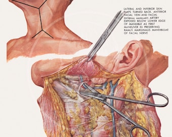 Plate 1: Radical Neck Dissection - 10x14 Giclée Canvas Print of Vintage Surgical Illustration