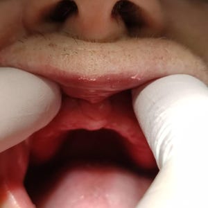 Pack de prótesis fijas y removibles