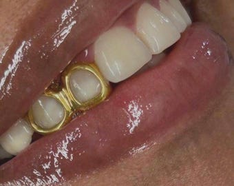Könnte beinhalten: Ein Gold-Zahngrill, der zwei nebeneinanderliegende Zähne bedeckt und eine glatte, polierte metallische Oberfläche aufweist, die den natürlichen weißen Zahnschmelz einrahmt. Das Goldstück sitzt fest auf den Zähnen und zeigt eine helle, reflektierende Oberfläche.