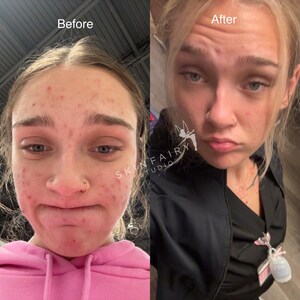 May include: A split image showing a person's face before and after a skincare treatment. The left side, labeled "Before," shows visible acne. The right side, labeled "After," shows a clearer complexion. The Skin Fairy Studio logo is visible.