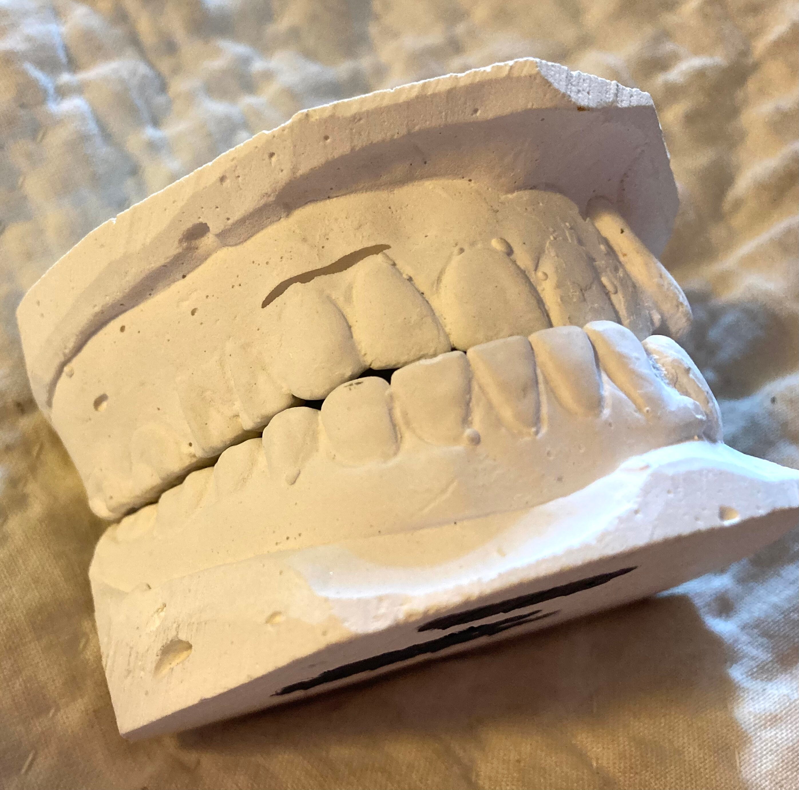 Disease Teeth Model, Dental Mold, Clear Dental Teeth Model, Vintage Medical  