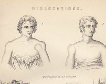 DISLOCATION - Limbs Joints Antique Anatomy Print - printed 1890 - Engraving