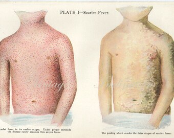 1911  SCARLET FEVER plate 1 Human Anatomy Print, bookplate chart