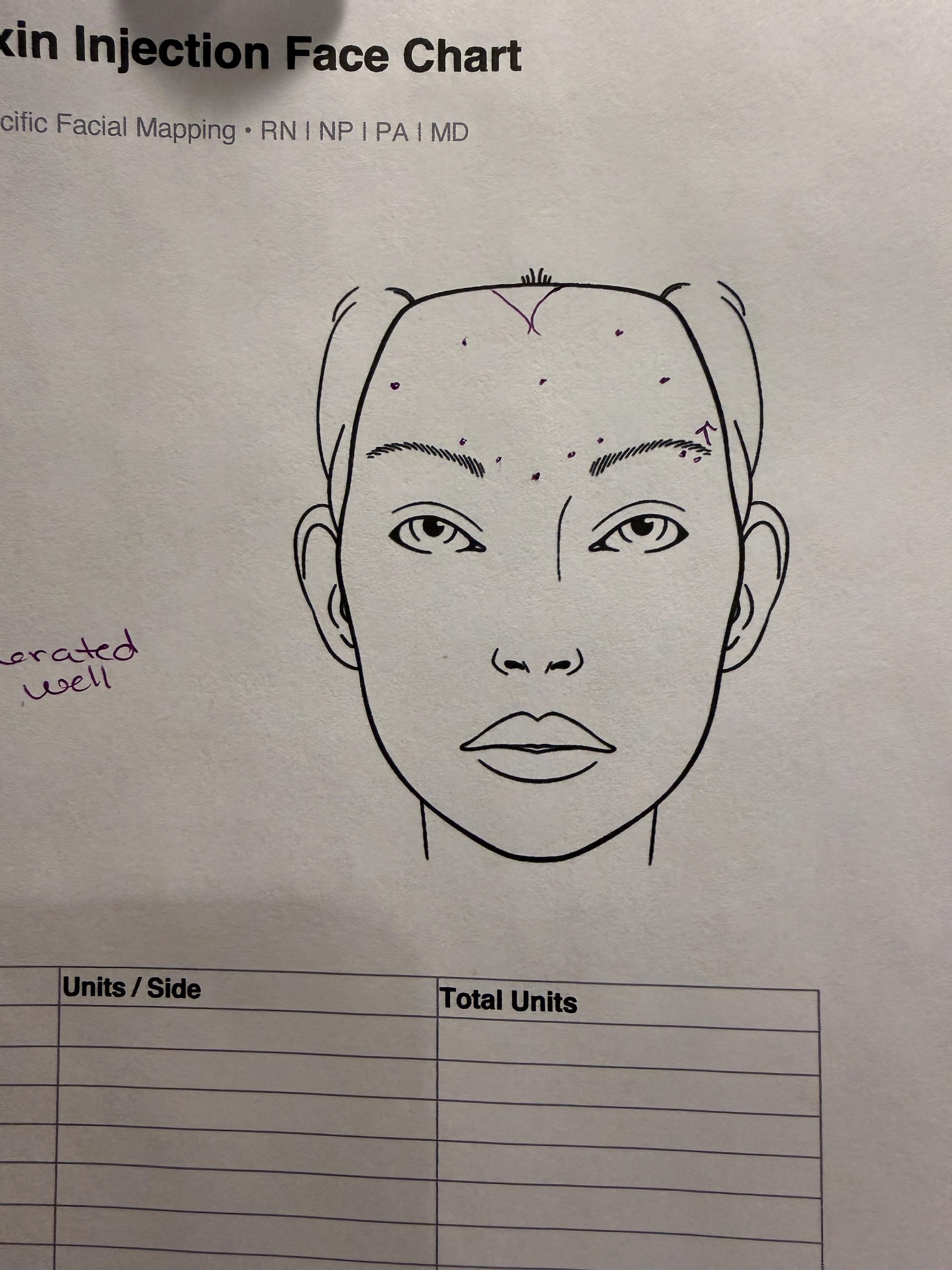 Neurotoxin Injection Face Chart | Patient Facial Mapping PDF | Botox ...