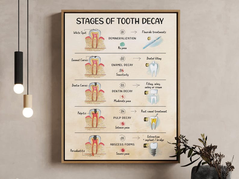 Stages of Tooth Decay - Wall Art: Cavity Progression Poster, Dental ...