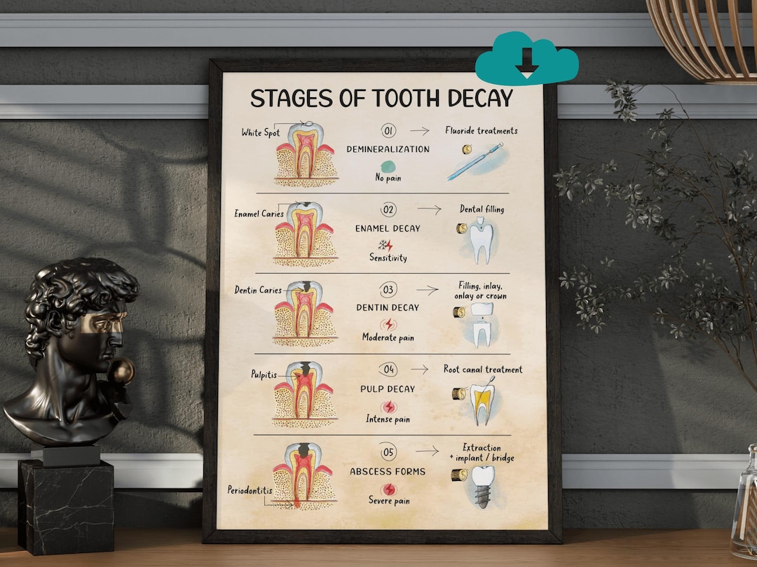 Stages of Tooth Decay - Wall Art: Cavity Progression Poster, Dental ...